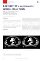 F-18 FDG PET/CT in pulmonary artery sarcoma: clinical vignette